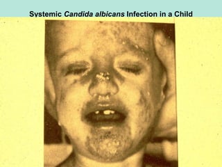 Systemic Candida albicans Infection in a Child
 