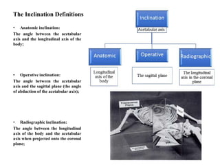 Acetabular component alignment guide in total hip replacement | PPTX