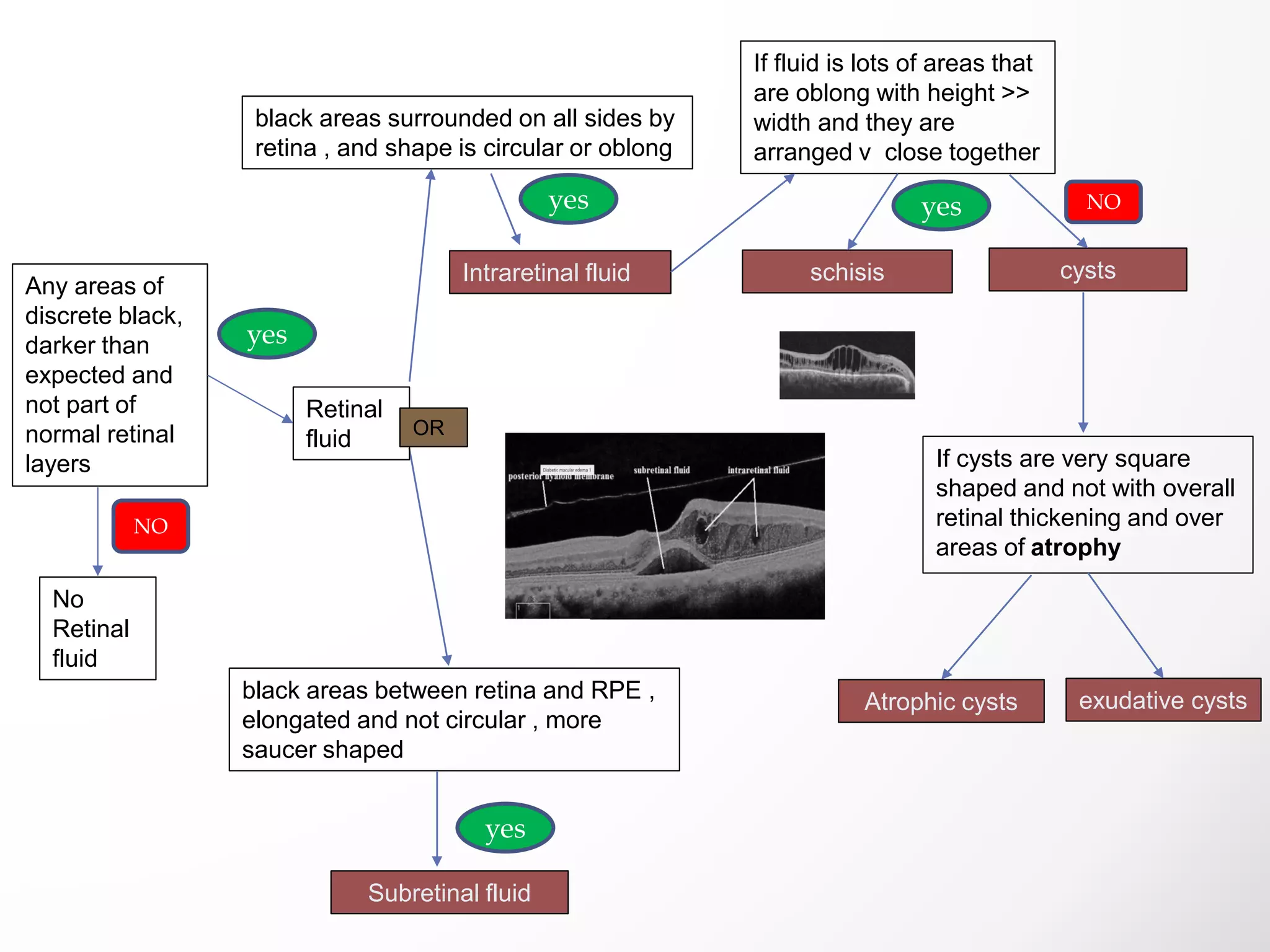 black areas surrounded on all sides by
retina , and shape is circular or oblong
black areas between retina and RPE ,
elongated and not circular , more
saucer shaped
If fluid is lots of areas that
are oblong with height >>
width and they are
arranged v close together
If cysts are very square
shaped and not with overall
retinal thickening and over
areas of atrophy
exudative cysts
Any areas of
discrete black,
darker than
expected and
not part of
normal retinal
layers
Subretinal fluid
Intraretinal fluid schisis cysts
Atrophic cysts
Retinal
fluid
No
Retinal
fluid
OR
yes
NO
NO
yes
yes
yes
 