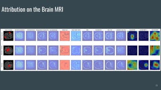 Attribution on the Brain MRI
15
 