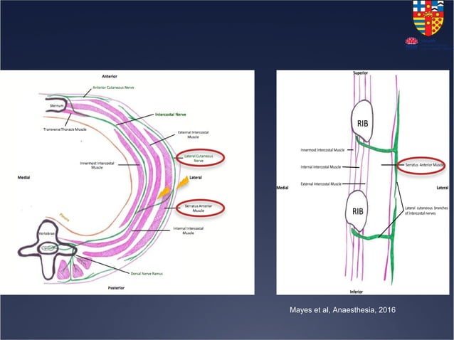 Interpectoral Block Serratus Anterior Plane Block | PPT
