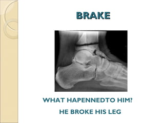 BRAKE WHAT HAPENNEDTO HIM?  HE BROKE HIS LEG  