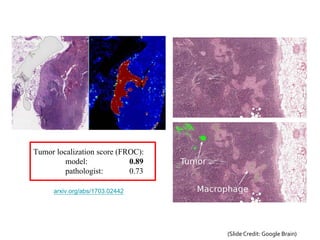 arxiv.org/abs/1703.02442
Tumor localization score (FROC):
model: 0.89
pathologist: 0.73
(Slide Credit: Google Brain)
 