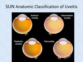 Uvetis, anterior uveitis, posterior uveitis | PDF
