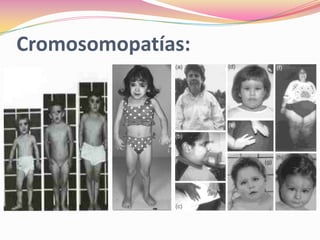 Cromosomopatías:
 