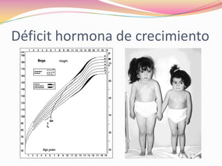 Déficit hormona de crecimiento
 