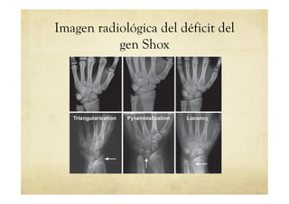 Imagen radiológica del déficit del
gen Shox
 