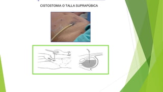 exposici-n-de-talla-vesical-exponer-2-pdf