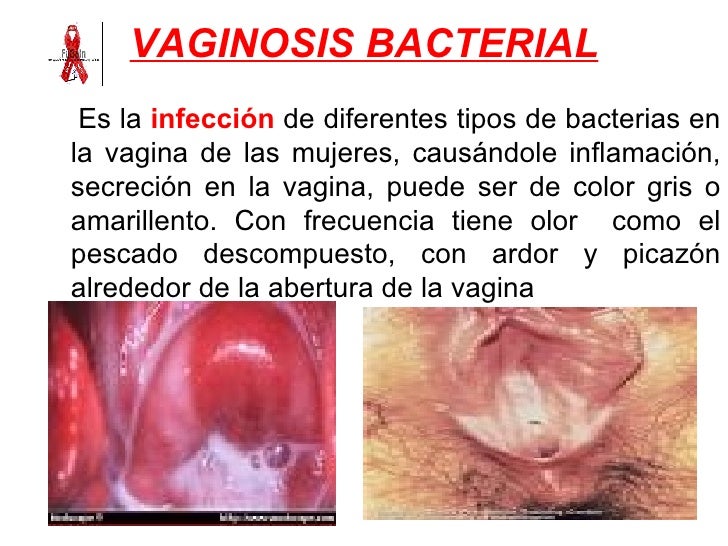 Fotos verrugas genitales hombres mujeres 68 Fotos verrugas genitales hombres mujeres 91