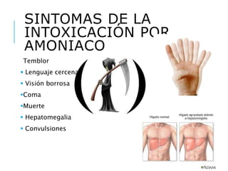 SINTOMAS DE LA
INTOXICACIÓN POR
AMONIACO
Temblor
 Lenguaje cercenado
 Visión borrosa
Coma
Muerte
 Hepatomegalia
 Convulsiones
 