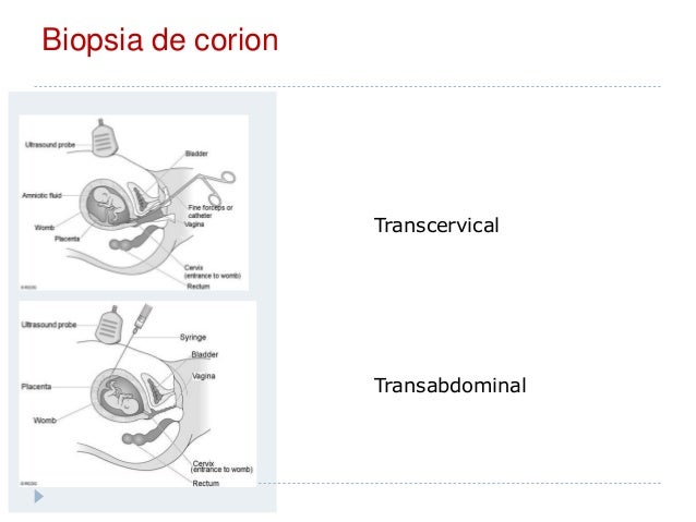 Cuantos Días Se Sangra Después De Una Biopsia Corial es.slideshare.net