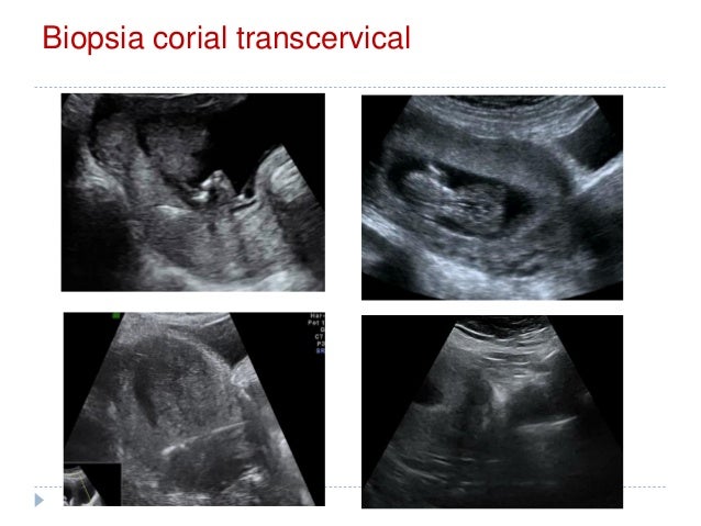 Cuantos Días Se Sangra Después De Una Biopsia Corial es.slideshare.net