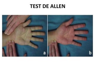 TEST DE ALLEN
 