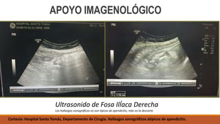 Ultrasonido de Fosa IlÍaca Derecha
Los hallazgos sonográficos no son típicos de apendicitis, más no la descarta
APOYO IMAGENOLÓGICO
Cortesía: Hospital Santo Tomás, Departamento de Cirugía. Hallazgos sonográfícos atípicos de apendicitis.
 