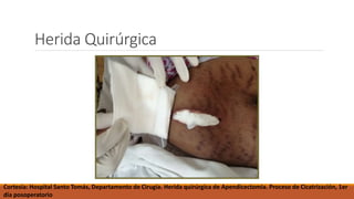 Herida Quirúrgica
Cortesía: Hospital Santo Tomás, Departamento de Cirugía. Herida quirúrgica de Apendicectomia. Proceso de Cicatrización, 1er
día posoperatorio
 