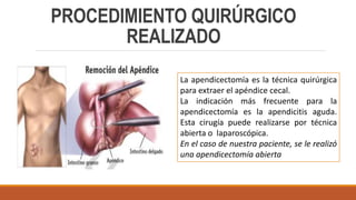 PROCEDIMIENTO QUIRÚRGICO
REALIZADO
La apendicectomía es la técnica quirúrgica
para extraer el apéndice cecal.
La indicación más frecuente para la
apendicectomía es la apendicitis aguda.
Esta cirugía puede realizarse por técnica
abierta o laparoscópica.
En el caso de nuestra paciente, se le realizó
una apendicectomía abierta
 