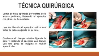 Cortar el meso apéndice por dentro de la
arteria pedicular, liberando el apéndice
con pinzas de hemostasia.
Una vez liberado el apéndice realizar una
bolsa de tabaco o jareta en su base.
Comienza el tiempo séptico ligando la
base y cortando el apéndice con bisturí.
Con una pinza se invagina el muñón
apendicular.
TÉCNICA QUIRÚRGICA
 