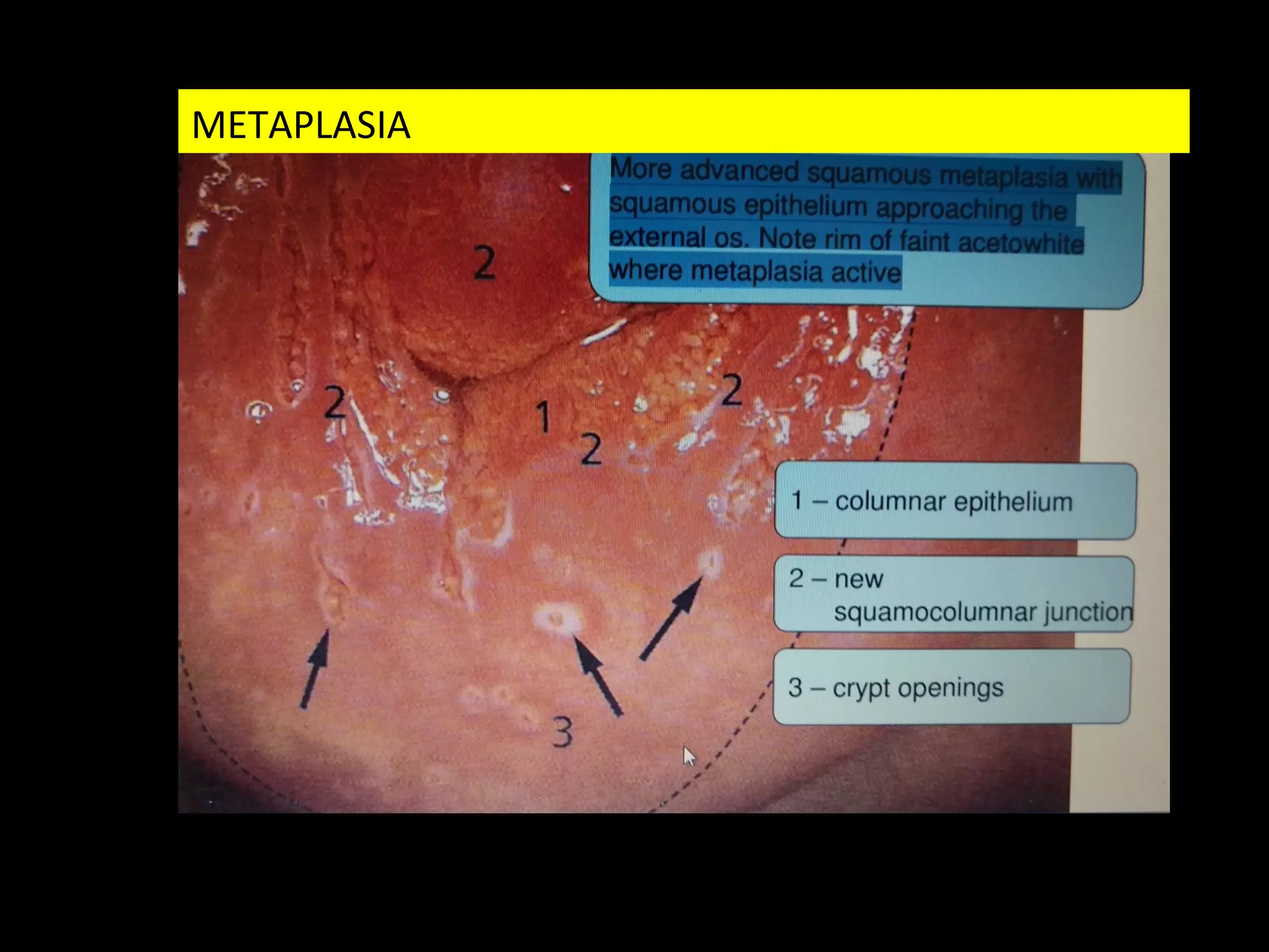 Taller b zona de transformacion metaplasia | PPT