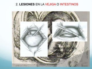 2. LESIONES EN LA VEJIGA O INTESTINOS
 
