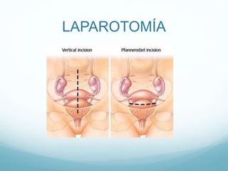 LAPAROTOMÍA
 