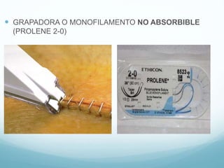  GRAPADORA O MONOFILAMENTO NO ABSORBIBLE
(PROLENE 2-0)
 