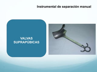 VALVAS
SUPRAPÚBICAS
.
Instrumental de separación manual
 