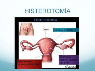 HISTEROTOMÍA
 