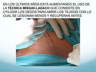 EN LOS ÚLTIMOS AÑOS ESTÁ AUMENTANDO EL USO DE
LA TÉCNICA MISGAV-LADACH QUE CONSISTE EN
UTILIZAR LOS DEDOS PARA ABRIR LOS TEJIDOS CON LO
CUAL SE LESIONAN MENOS Y RECUPERAN ANTES.
 