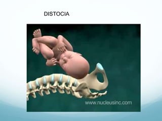DISTOCIA
 