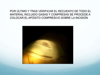 POR ÚLTIMO Y TRAS VERIFICAR EL RECUENTO DE TODO EL
MATERIAL INCLUIDO GASAS Y COMPRESAS SE PROCEDE A
COLOCAR EL APÓSITO COMPRESIVO SOBRE LA INCISIÓN
 