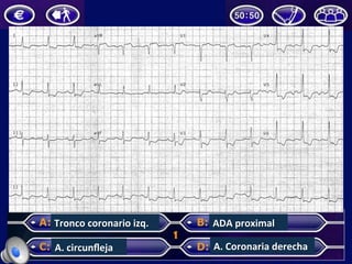 Tronco	
  coronario	
  izq.	
  
A.	
  circunﬂeja	
  
ADA	
  proximal	
  
A.	
  Coronaria	
  derecha	
  
 