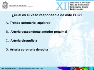 ¿Cual es el vaso responsable de este ECG?
A.  Tronco coronario izquierdo
B.  Arteria descendente anterior proximal
C.  Arteria circunfleja
D.  Arteria coronaria derecha	
  
 