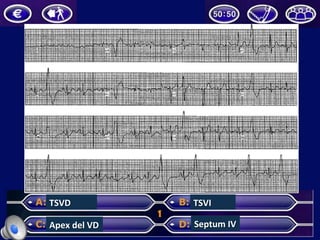 TSVD	
  
Apex	
  del	
  VD	
  
TSVI	
  
Septum	
  IV	
  
 
