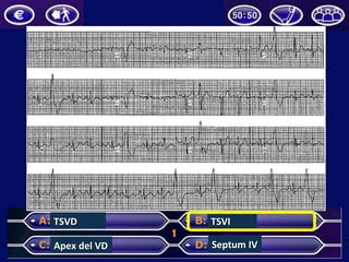TSVD	
  
Apex	
  del	
  VD	
  
TSVI	
  
Septum	
  IV	
  
 