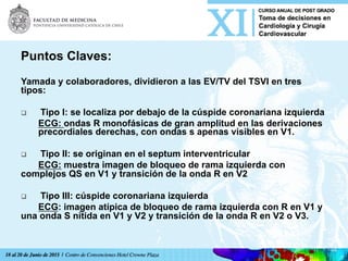 Puntos Claves:
Yamada y colaboradores, dividieron a las EV/TV del TSVI en tres
tipos:
q  Tipo I: se localiza por debajo de la cúspide coronariana izquierda
ECG: ondas R monofásicas de gran amplitud en las derivaciones
precordiales derechas, con ondas s apenas visibles en V1.
q  Tipo II: se originan en el septum interventricular
ECG: muestra imagen de bloqueo de rama izquierda con
complejos QS en V1 y transición de la onda R en V2
q  Tipo III: cúspide coronariana izquierda
ECG: imagen atípica de bloqueo de rama izquierda con R en V1 y
una onda S nítida en V1 y V2 y transición de la onda R en V2 o V3.
 