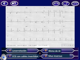 Levorrotación	
  
ECG	
  con	
  cables	
  inverUdos	
   Situs	
  inversus	
  
Ritmo	
  de	
  AI	
  
 