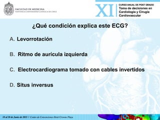 ¿Qué condición explica este ECG?
A.  Levorrotación
B.  Ritmo de aurícula izquierda
C.  Electrocardiograma tomado con cables invertidos
D.  Situs inversus	
  
 