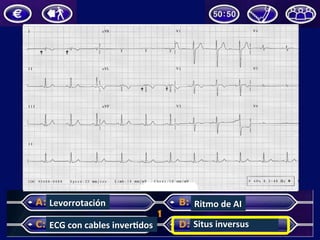 Levorrotación	
  
ECG	
  con	
  cables	
  inverUdos	
   Situs	
  inversus	
  
Ritmo	
  de	
  AI	
  
 