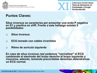 Puntos Claves:
Situs inversus se caracteriza por presentar una onda P negativa
en D1 y positiva en aVR. Frente a este hallazgo existen 3
posibilidades:
q  Situs inversus
q  ECG tomado con cables invertidos
q  Ritmo de aurícula izquierda
En caso de situs inversus real podemos "normalizar" el ECG
cambiando el electrodo del brazo derecho al brazo izquierdo y
viceversa, además, tomando precordiales derechas obtendremos
un ECG normal.
 