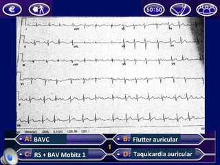BAVC	
  
RS	
  +	
  BAV	
  Mobitz	
  1	
  
FluZer	
  auricular	
  
Taquicardia	
  auricular	
  
 