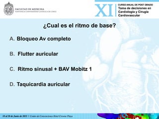 ¿Cual es el ritmo de base?
A.  Bloqueo Av completo
B.  Flutter auricular
C.  Ritmo sinusal + BAV Mobitz 1
D.  Taquicardia auricular	
  
 