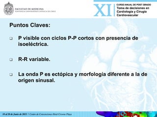 Puntos Claves:
q  P visible con ciclos P-P cortos con presencia de
isoeléctrica.
q  R-R variable.
q  La onda P es ectópica y morfología diferente a la de
origen sinusal.
	
  
 