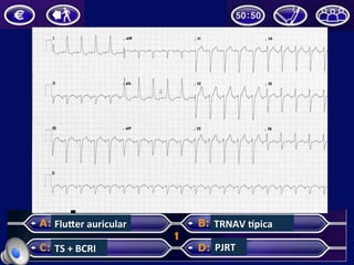 FluZer	
  auricular	
  
TS	
  +	
  BCRI	
  
TRNAV	
  pica	
  
PJRT	
  
 
