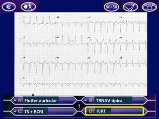 FluZer	
  auricular	
  
TS	
  +	
  BCRI	
  
TRNAV	
  pica	
  
PJRT	
  
 