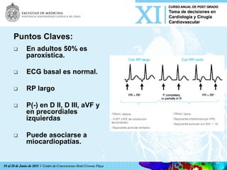 Puntos Claves:
q  En adultos 50% es
paroxística.
q  ECG basal es normal.
q  RP largo
q  P(-) en D II, D III, aVF y
en precordiales
izquierdas
q  Puede asociarse a
miocardiopatías.
 