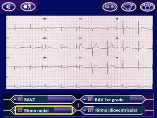 BAVC	
  
Ritmo	
  nodal	
  
BAV	
  1er	
  grado	
  
Ritmo	
  idioventricular	
  
 