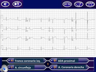 Tronco	coronario	izq.	
A.	circunﬂeja	
ADA	proximal	
A.	Coronaria	derecha	
 
