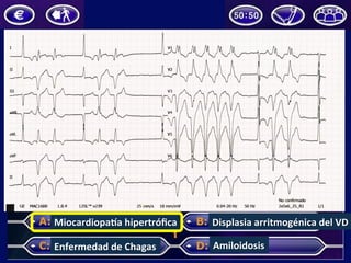 Miocardiopaja	hipertróﬁca	
Enfermedad	de	Chagas	
Displasia	arritmogénica	del	VD	
Amiloidosis	
 