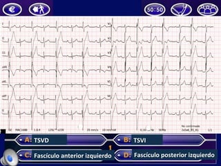 TSVD	
Fascículo	anterior	izquierdo	
TSVI	
Fascículo	posterior	izquierdo	
 