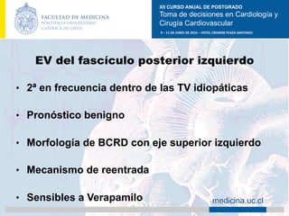 XII CURSO ANUAL DE POSTGRADO
Toma de decisiones en Cardiología y
Cirugía Cardiovascular
9	–	11	DE	JUNIO	DE	2016	–	HOTEL	CROWNE	PLAZA	SANTIAGO	
		 medicina.uc.cl
EV del fascículo posterior izquierdo
•  2ª en frecuencia dentro de las TV idiopáticas
•  Pronóstico benigno
•  Morfología de BCRD con eje superior izquierdo
•  Mecanismo de reentrada
•  Sensibles a Verapamilo
	
 